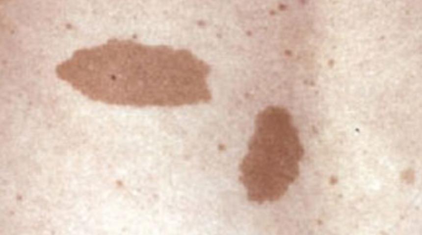 NF Nedir? (Nörofibromatozis)