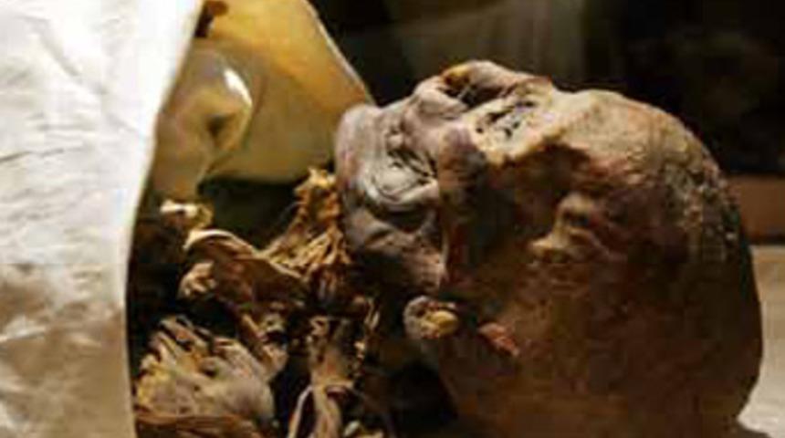 Mumyada kanser bulundu