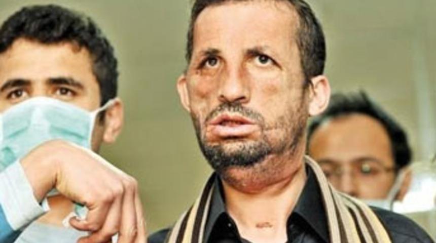 Y&uuml;z nakli r&ouml;portajı krize neden oldu