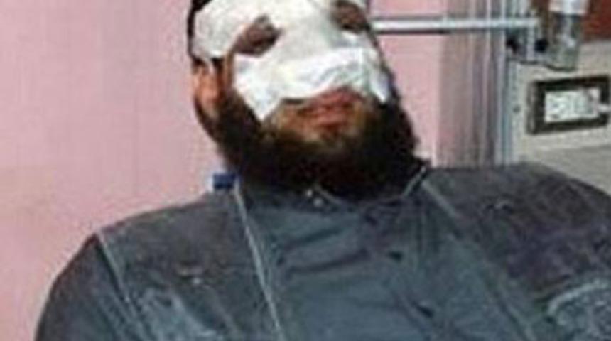 Burun estetiği vekillikten etti!