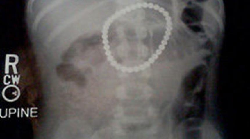 37 tane mıknatıs yuttu!