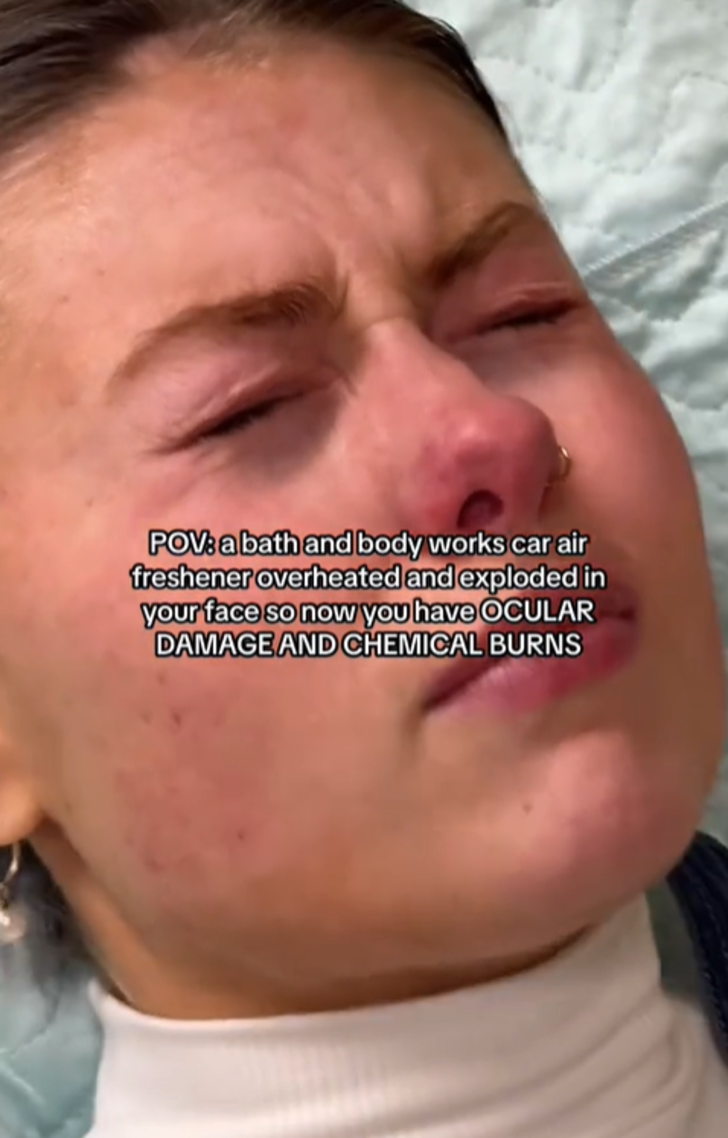 Oda spreyi bir anda patlayan kadın hastanelik oldu! O anları sosyal medyadan paylaşınca gündem yarattı G1