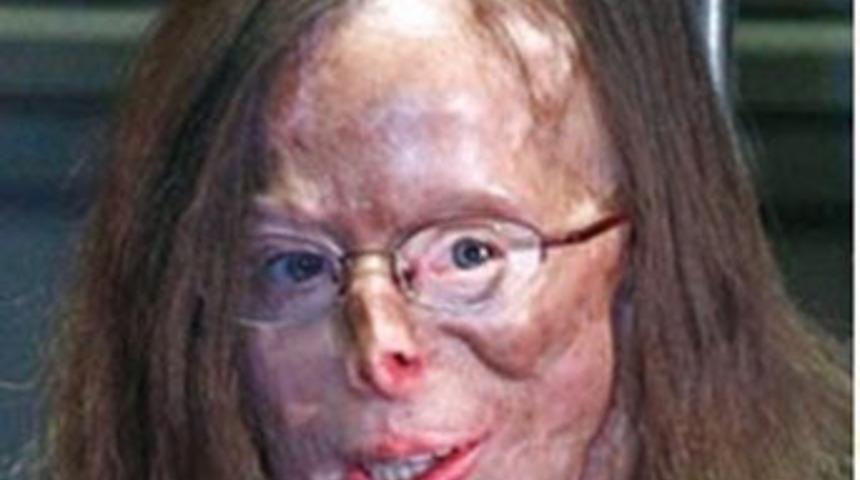 Asit atılan yüze 86 ameliyat