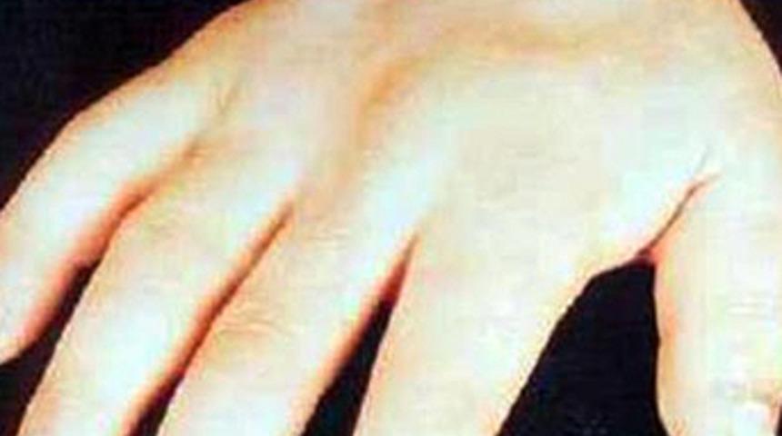 Sinsi hastalık &ouml;ld&uuml;r&uuml;yor