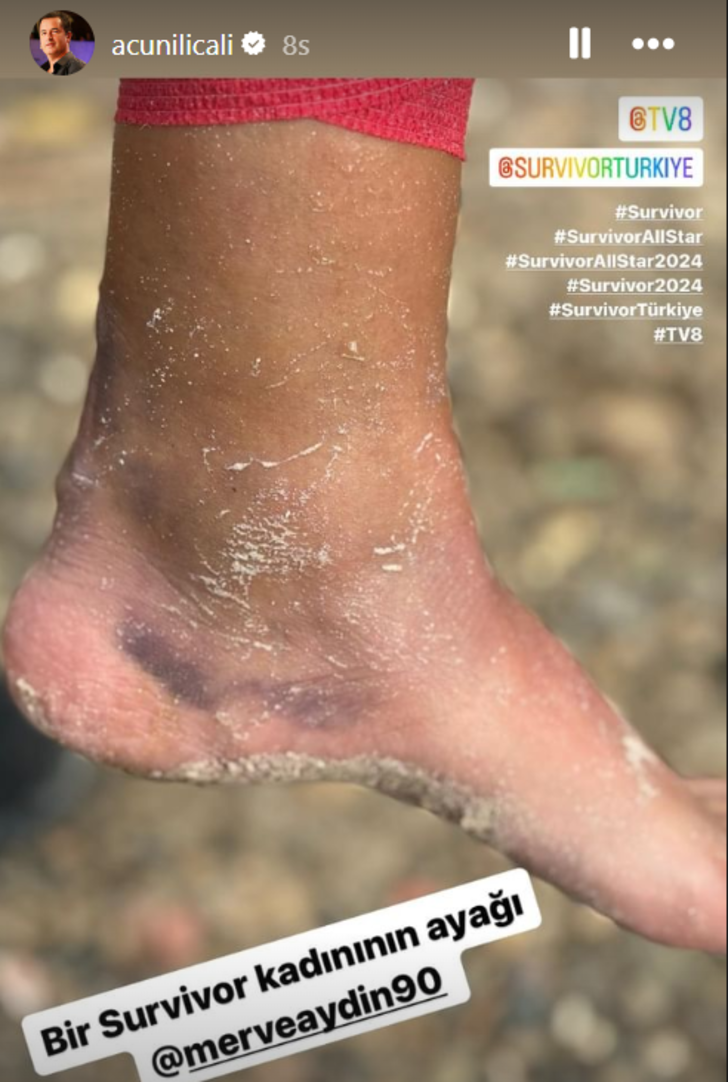 Acun Ilıcalı, 'Bir Survivor kadınının ayağı' diyerek paylaştı! Merve Aydın'ın ayağı sosyal medyayı salladı G2