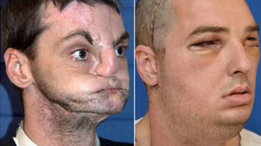 Yeni bir yüz nakli!