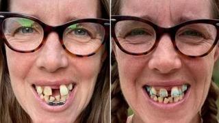 Çarpık dişleri yüzünden 'köpekbalığı' gibi göründüğünü düşünen kadın, çarpıcı yeni görünümüyle büyüledi!