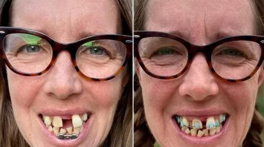 &Ccedil;arpık dişleri y&uuml;z&uuml;nden 'k&ouml;pekbalığı' gibi g&ouml;r&uuml;nd&uuml;ğ&uuml;n&uuml; d&uuml;ş&uuml;nen kadın, &ccedil;arpıcı yeni g&ouml;r&uuml;n&uuml;m&uuml;yle b&uuml;y&uuml;ledi!