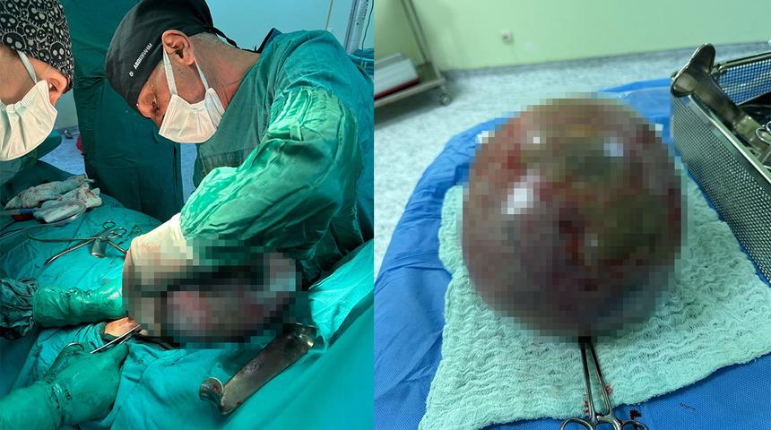 Ağrı şikayetiyle hastaneye gitti, karnından çıkan şoke etti! Tam 10 kilo ağırlığında