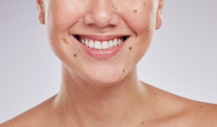 Hiçbiri tesadüf değil! Vücudunuzdaki benlerin ruhsal ve bedensel anlamları