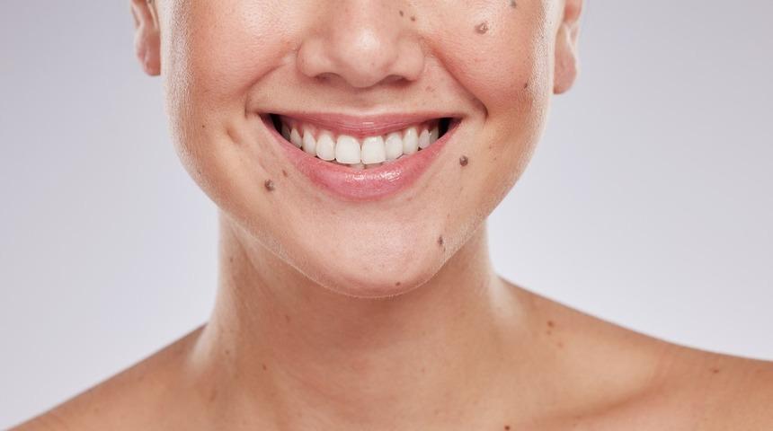 Hi&ccedil;biri tesad&uuml;f değil! V&uuml;cudunuzdaki benlerin ruhsal ve bedensel anlamları