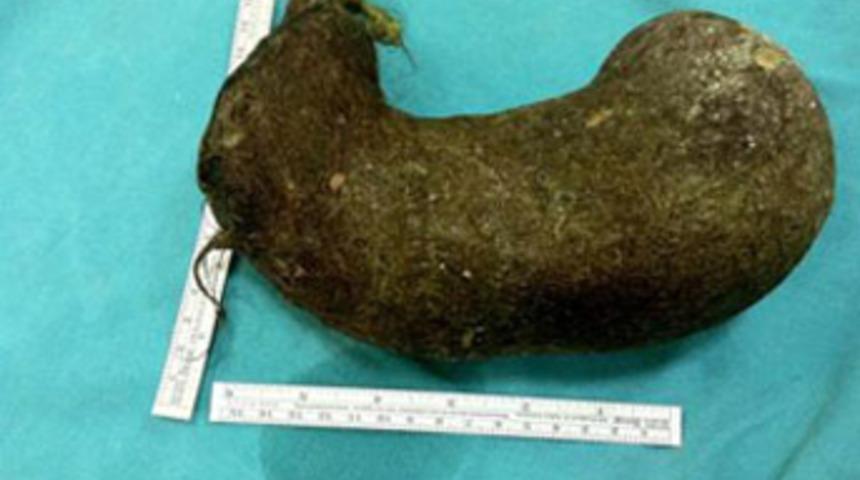 Midesinden öyle bir şey çıktı ki...