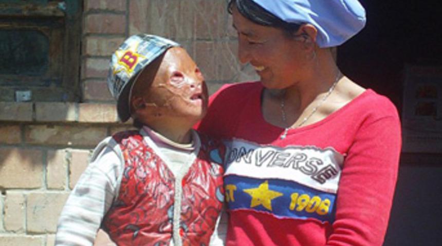 Y&uuml;z&uuml; ve elleri tamamen yandı!