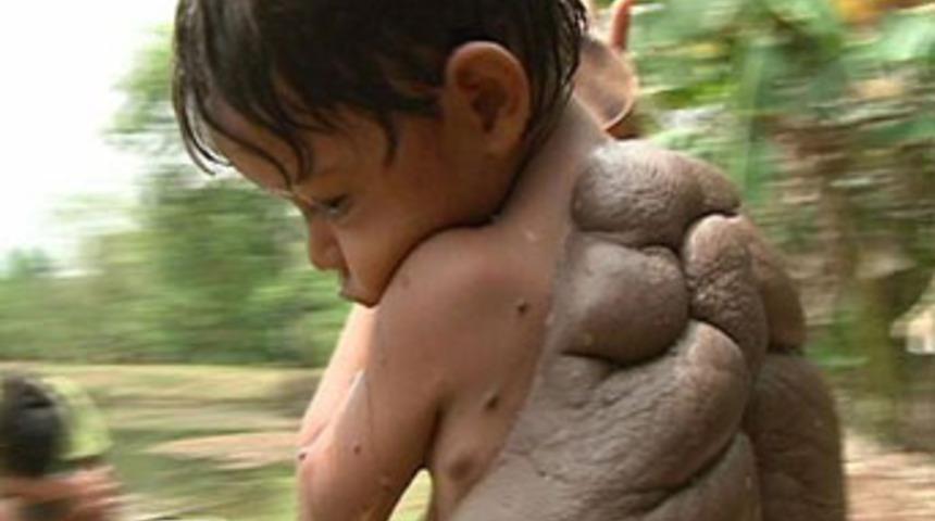 'Kaplumbağa' çocuk artık normal!