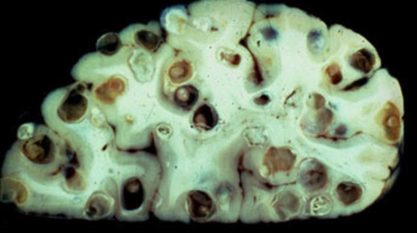 Gizli salgın hızla yayılıyor