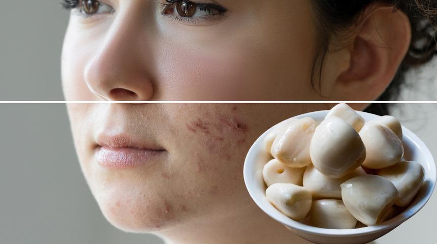 Yeni trend: Her gün bir tane yutun! Sivilcelerin kökünü kurutup pürüzsüz bir cilde kavuşturuyor