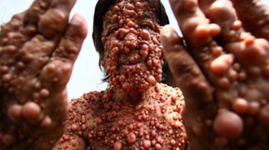 'Balon adam'ın dramı!