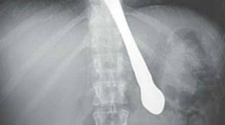 G&uuml;l&uuml;nce ağzındaki bı&ccedil;ağı yuttu!