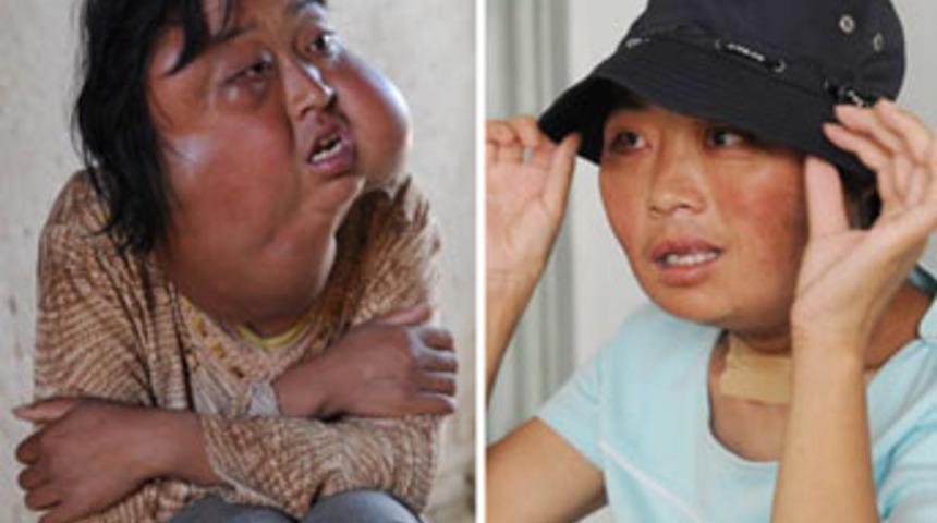 Kafasından 70 t&uuml;m&ouml;r alındı