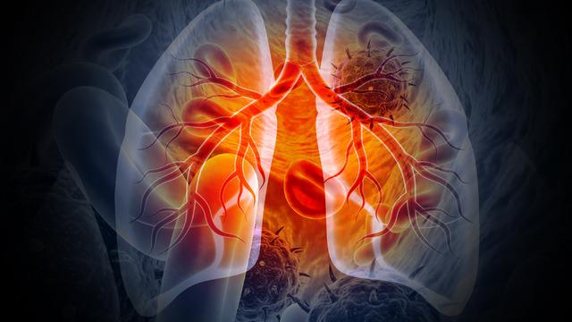 Akciğer kanseri nedir? Akciğer kanseri belirtileri nelerdir?