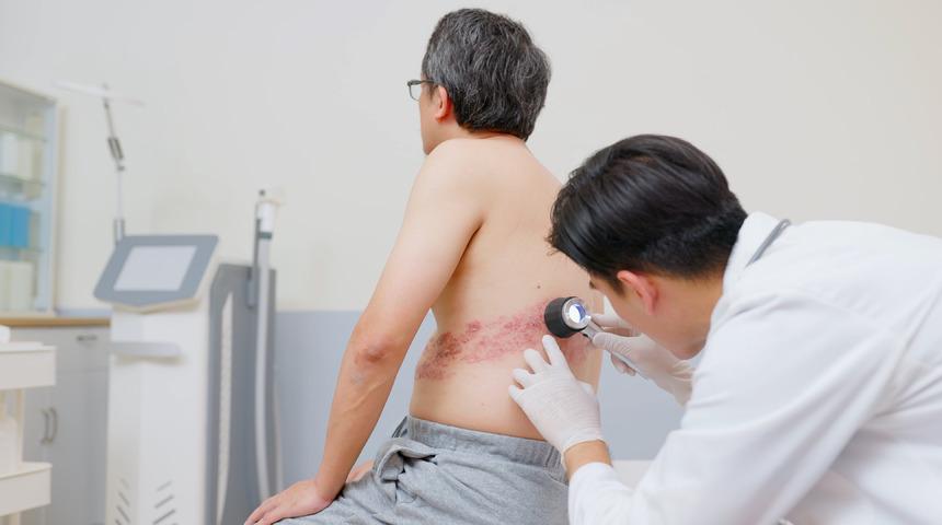 Zona hastalığı nedir, neden olur? Zonaya ne iyi gelir, nasıl geçer?