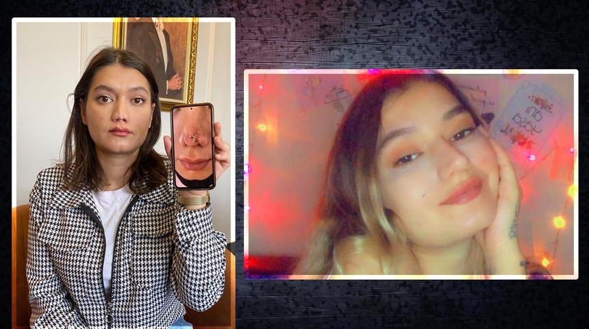 'Hayatım komple karardı' Estetik yaptırdı... Düğününü iptal etmek zorunda kaldı "Doktor dalga geçer gibi 'sen de ne kadar şanssızsın' dedi"