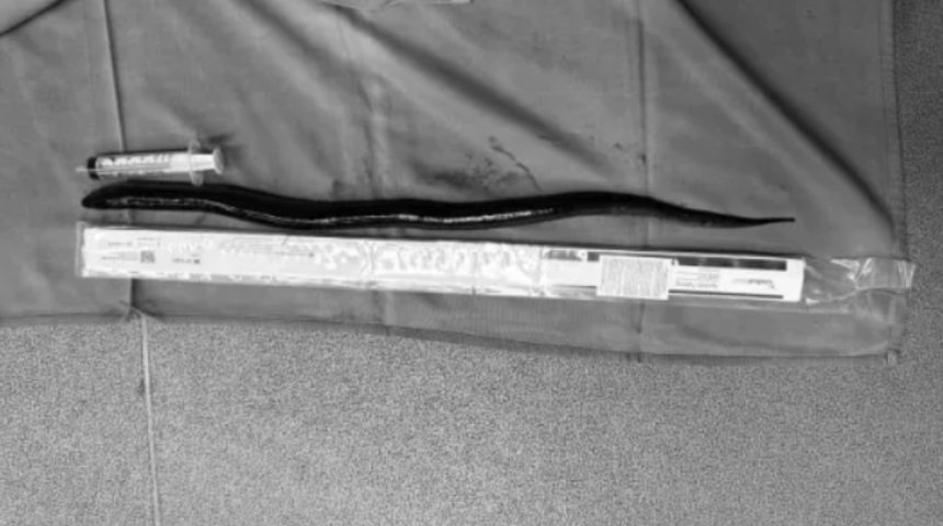 Herkesi şaşkına çeviren vaka! Cerrahlar adamın midesinden 30 cm uzunluğunda canlı yılan balığı çıkarttı