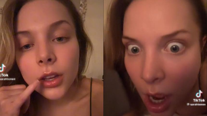 Dudağının etrafında &ccedil;ıkan sivilcelerle m&uuml;cadele ediyordu! Doktorun teşhisi sonrasında şaşkına d&ouml;nd&uuml;