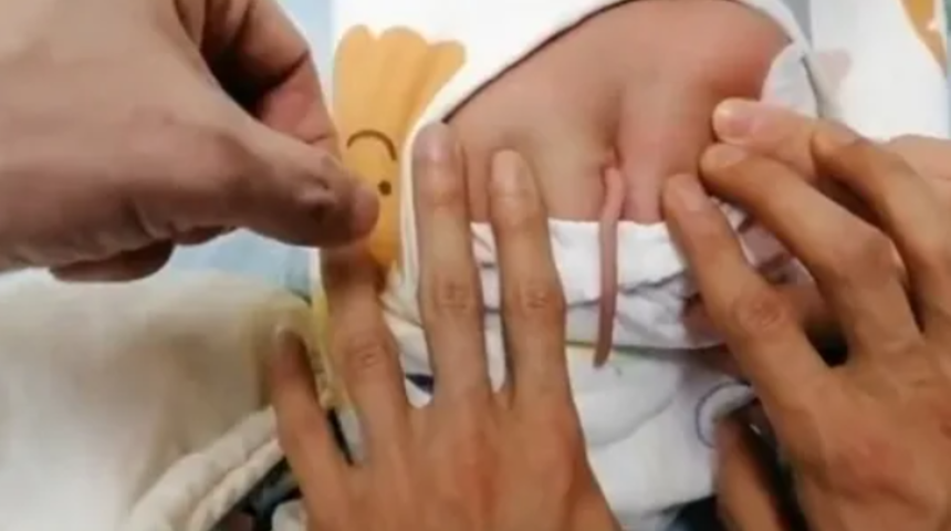 Yenidoğan bebek sırtında 10 santimlik kuyrukla dünyaya geldi! Gözlerine inanamadıkları için daha yakından bakmak istediler
