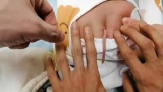 Yenidoğan bebek sırtında 10 santimlik kuyrukla dünyaya geldi! Gözlerine inanamadıkları için daha yakından bakmak istediler