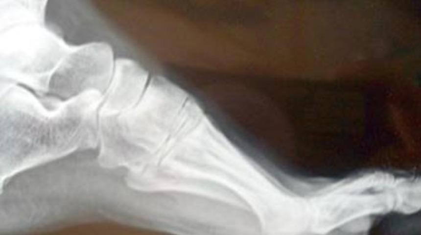 Yuttuğu iğne 2 yıl sonra ayağından &ccedil;ıktı!