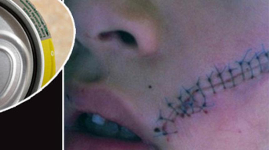 Kolayı soğuk i&ccedil;mek istedi, 38 dikiş atıldı!