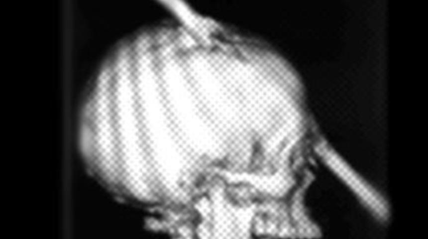 Kafasına 2 metrelik demirkazık d&uuml;şt&uuml;!