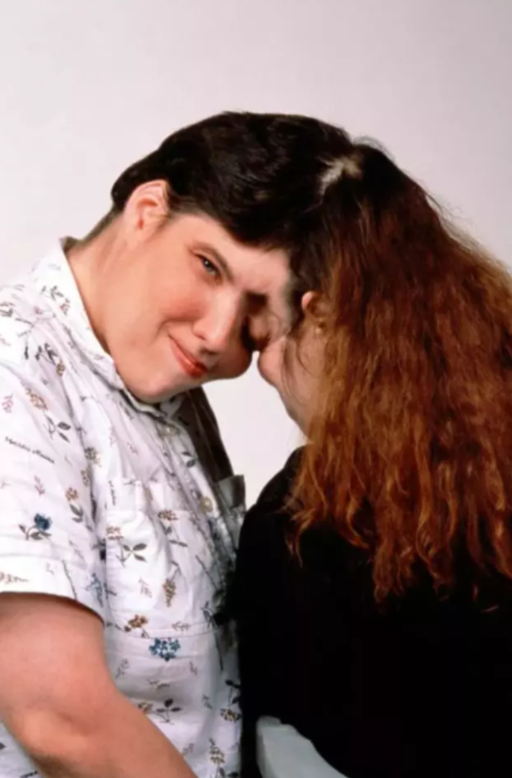 'Yatak odasında kardeşim yüzünü çeviyor' itirafıyla çok konuşulan yapışık ikizler 62 yaşında hayatını kaybetti G3