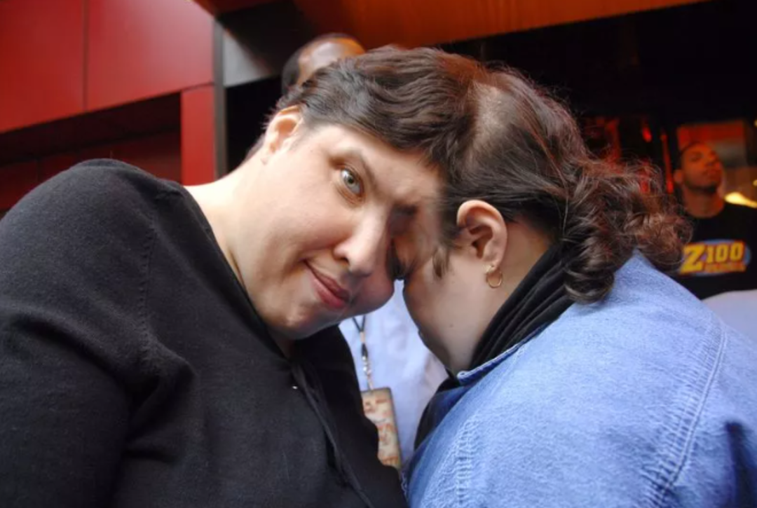 'Yatak odasında kardeşim y&uuml;z&uuml;n&uuml; &ccedil;eviyor' itirafıyla &ccedil;ok konuşulan yapışık ikizler 62 yaşında hayatını kaybetti