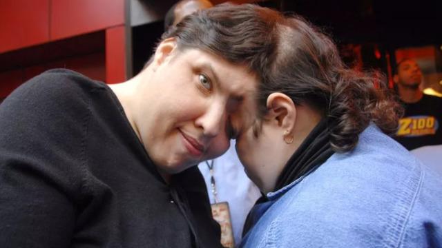 'Yatak odasında kardeşim yüzünü çeviyor' itirafıyla çok konuşulan yapışık ikizler 62 yaşında hayatını kaybetti