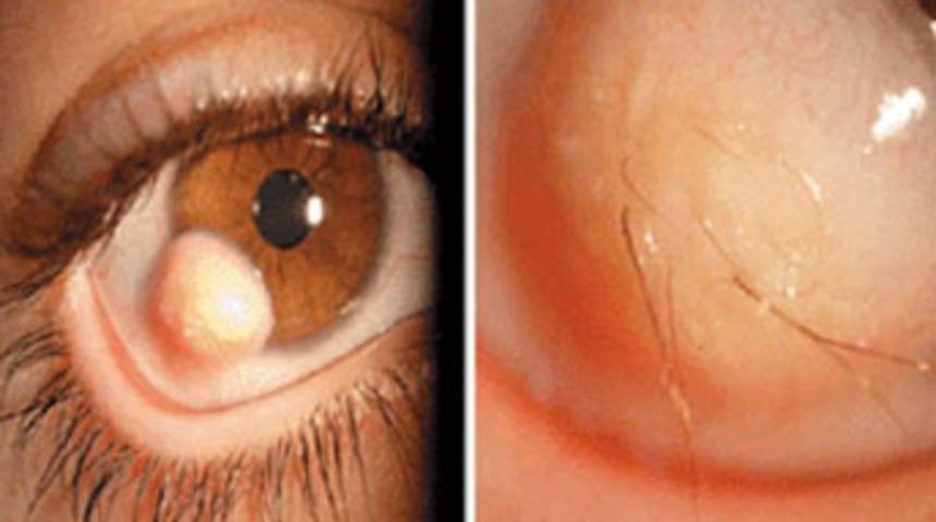 Göz yuvarlağından saç çıkıyor!