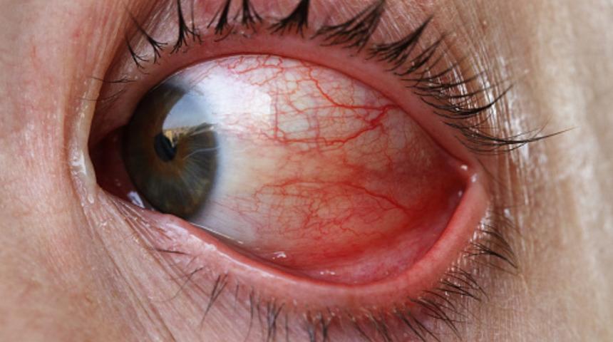 İstemsiz bir şekilde büyüyordu! Gözünden canlı solucan çıkarttılar... "Çoğu hasta semptom bile göstermiyor"