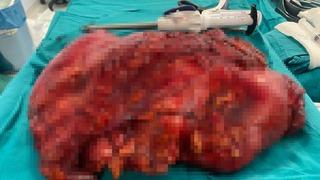 Böbrek ağrısı için gitti, karnından çıkan şoke etti! 'Gebe bir kadın gibiydim'