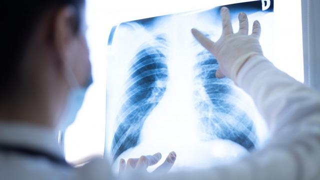 Erkeklerde görülüyordu! Kadınlarda artışa geçti... 'Dünyada en çok ölüme sebep olan tür'