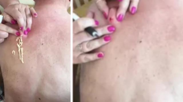 25 yıldır sırtında duran devasa kistin patladığı anı sosyal medyadan paylaştı! Bunu izlemeyi midem kaldırmaz