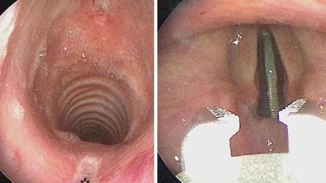 Ses kısıklığı ve yutma sorunu nedeniyle hastanelik oldu! Doktorları bile şaşırttı: Boğazında bozuk para sıkıştı