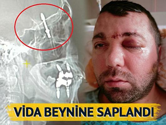 İmplant tedavisinde vida beynine saplandı... Doktorlar gözlerine inanamadı! "Bana hayatımı kaybedebileceğimi söylediler" Ameliyatı, Amerika'da dergilere konu oldu