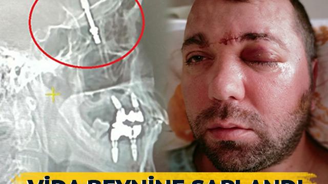 İmplant tedavisinde vida beynine saplandı... Doktorlar gözlerine inanamadı! Bana hayatımı kaybedebileceğimi söylediler Ameliyatı, Amerika'da dergilere konu oldu