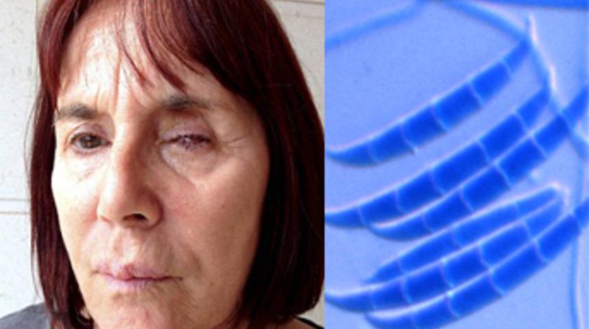 Kontakt lensteki böcek korneasını yedi