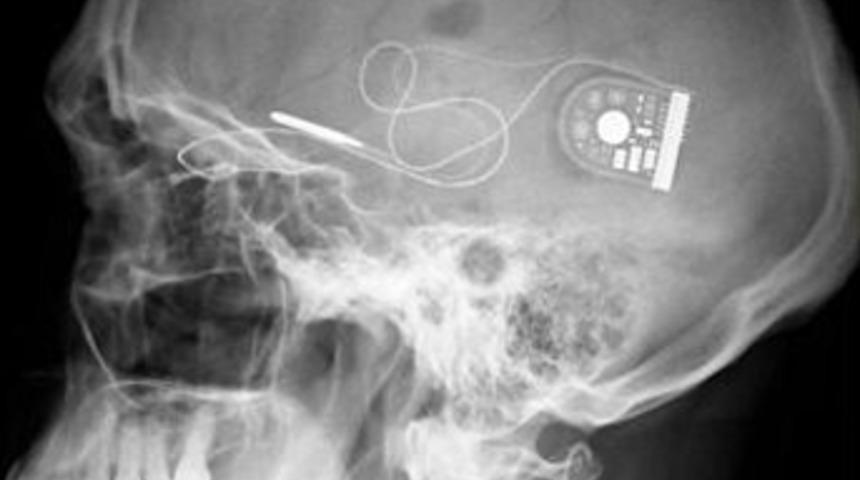 Mikro&ccedil;iple k&ouml;rl&uuml;ğe &ccedil;are