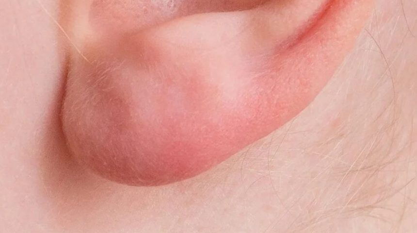 Kulak memesindeki çizgiye dikkat! Tehlikeli hastalığın riskini işaret ediyor