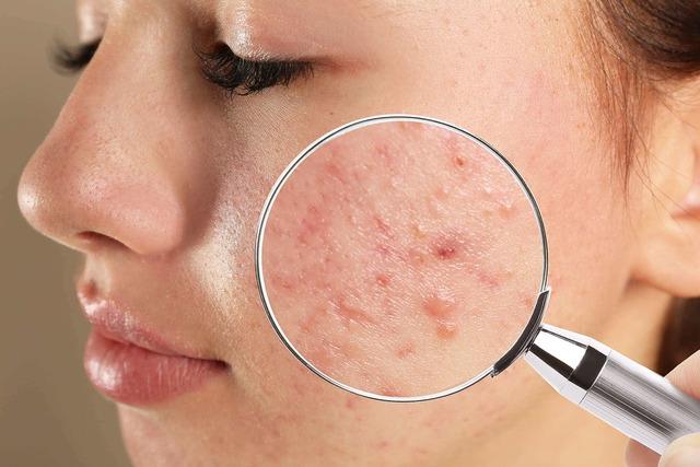 cystic-acne-treatment-in-Singapore