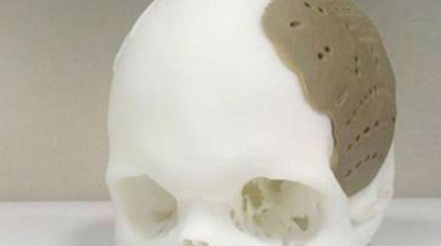 3D yazıcıda kafatası protezi üretildi