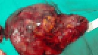 10 yıldır karın ağrısı çekiyordu, böbreğinden çıkan şaşkına çevirdi!